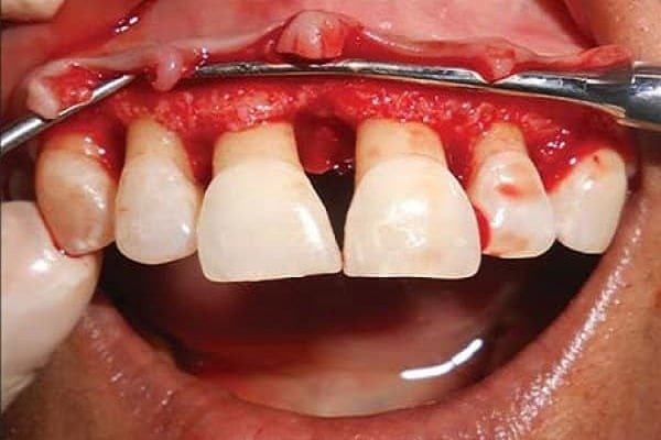 Gum Surgery